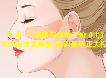 月 🐺 湖鹰钩鼻矫正价 🦍 格与术后效果解析(鹰钩鼻矫正大概需要多少钱)